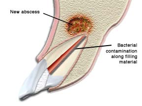 Endodontic Retreatment Illustration